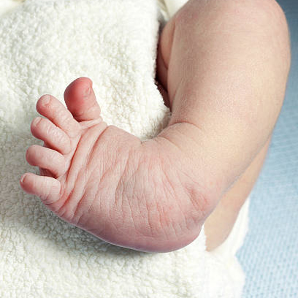 Baby w/ Clubfoot